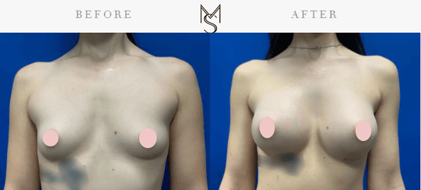 Breast Augmentation