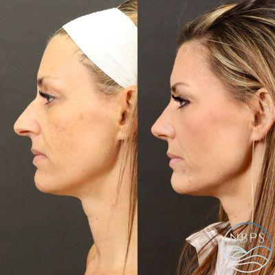 Rhinoplasty by Dr. Sailon