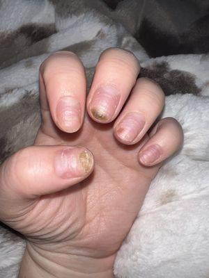 Fungus nails