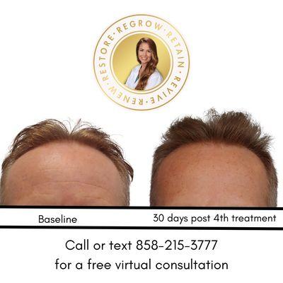 Alma TED Hair Restoration Treatment