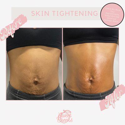 Before and after- Radio Frequency Skin Tightening