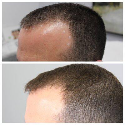 Before and after just 2 sessions of hair PRP! This patient was absolutely thrilled with these results!