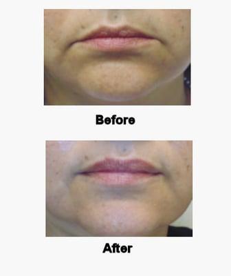 Botox for drooping lips