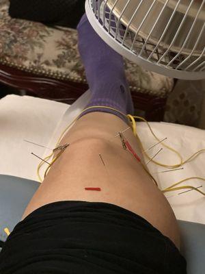 Acuhope Acupuncture