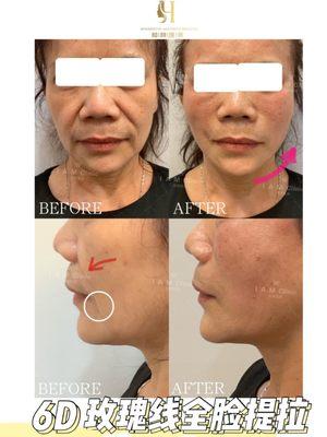 Whole face Thread lift right after procedure result