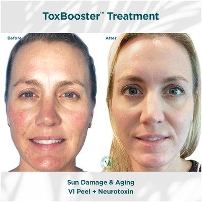 Sun Damage & Aging