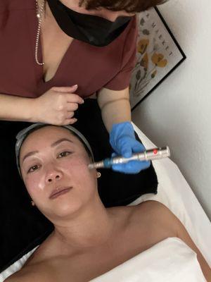 Microneedling in action