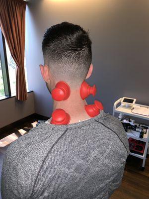 Pre-adjustment Cupping for his Migraines