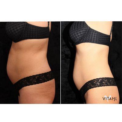 Before (left) and after (right) of trusculpt iD. 24% fat reduction per treament with this no downtime, non-invasive body contouring!