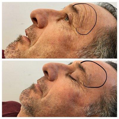 Cryoskin Toning Facial, Before & After