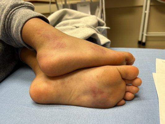 How my son's feet looked when the doctor said maybe it was a mosquito bite and that he'd be fine.