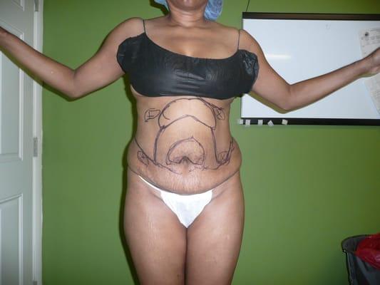 A typical liposuction patient , here for smart liposuction  of the abdomen
Initial Preop pictures