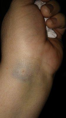 Another large bruise from taking blood