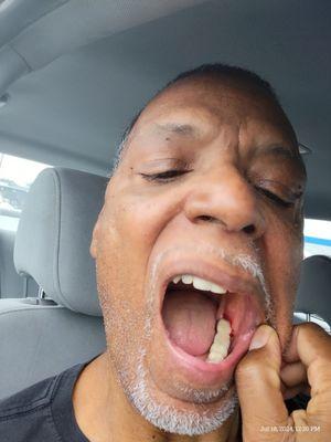 The damage that was done to my inner jaw while at my routine cleaning visit at Dental Dreams in Harrisburg PA.