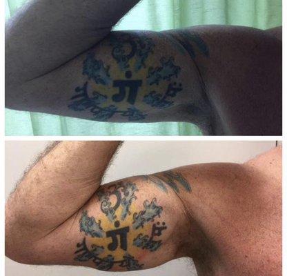 Biceps and triceps augmentation using silicone implants.