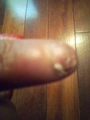 This is my poor little nail. It tore half way down the nail bed. Looks really ugly now. Please don't let this happen to you too.