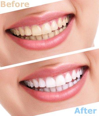 Thinking about teeth whitening? We use ZOOM! Teeth Whitening system.