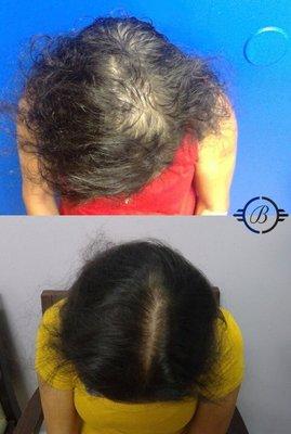 Plasma Rejuvenation for Hair Growth