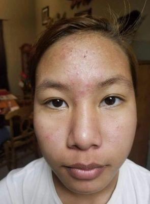 My daughter have problem about acne because her hormones imbalances when she turn to teenagers