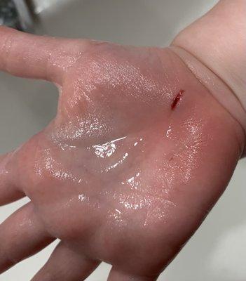 Puncture wound in 2 year olds hand from exposed carpet tac.