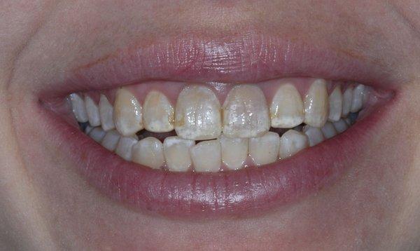 Porcelain Veneers, Before