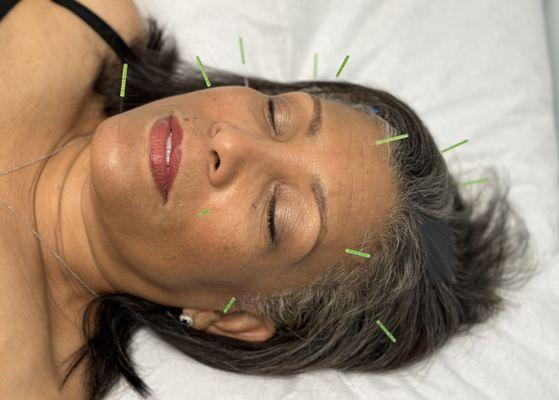 Facial needling for sleep & stress