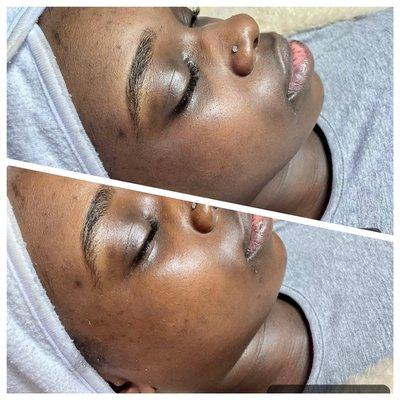 Microdermabrasion Results