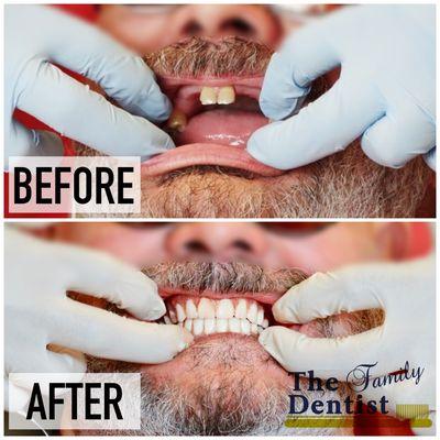 Real people, real smilesThis is the case of a 8 teeth removal and immediate insertion of new dentures. Make your appointment at 7173947218