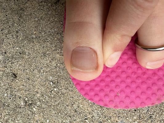 Bloody toe and jagged nail.