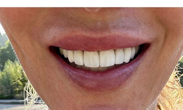 Dr. Samsavars veneers