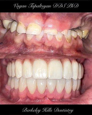 Full Mouth Rehabilitation with All-on-6 and crowns