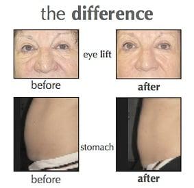 MICROCURRENT FACE /BODY LIFT