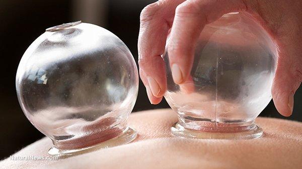 Peng Massage will help your feel so much better using Chinese cupping to relief stress, fatigue and minor aches and pains!