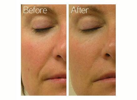 Hydrafacial before and afters. The Hydrafacial helps with fine lines, wrinkles, and hyper-pigmentation!