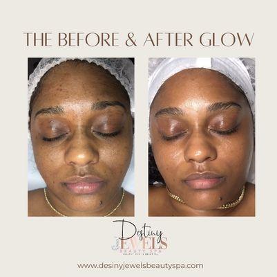 Deep exfoliating monthly facial results