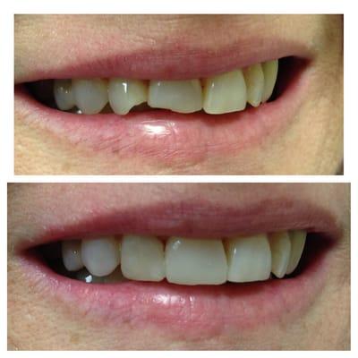 Broken and crowded anterior teeth, placed a bonding filling in the same day with no need for crown or braces. A smile makeover in one visit.