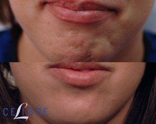 Pebble chin treated with Botox, Dysport.