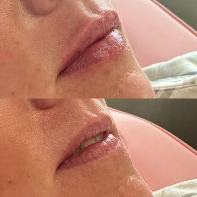 RHA Lip Filler