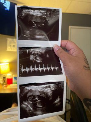 The scan room & my ultrasound picture