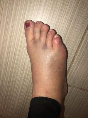 Crushed foot