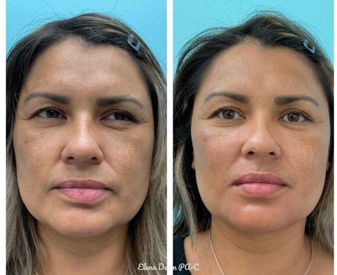 Elena PA-C , used Voluma to treat Cheeks and Periform Fossa. Then used RHA3 to fill Nasolabial Folds, Marionette Lines, Oral Commissures.