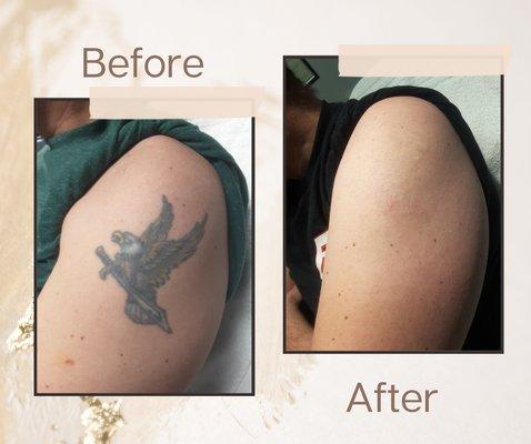 Before and After of Laser Tattoo removal.