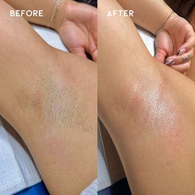 Before and after an underarm wax!