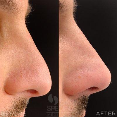 Non-surgical nose augmentation with dermal filler