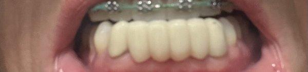 Discolored Too big/tall  Not my teeth from my impressions  Sliver showing  Bad dental bridge