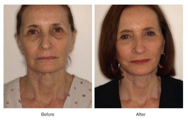 Vertical Vector Facelift with Corset Platysmaplasty