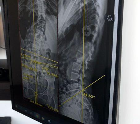 Have you seen your full spine x-rays?