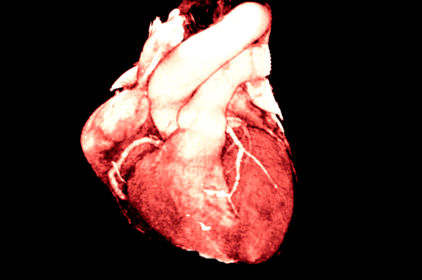 CT Coronary Angiogram