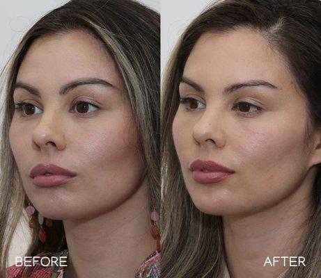 The chin was enhanced with filler to balance out her naturally full cheeks. Botox was used to lift the brows.