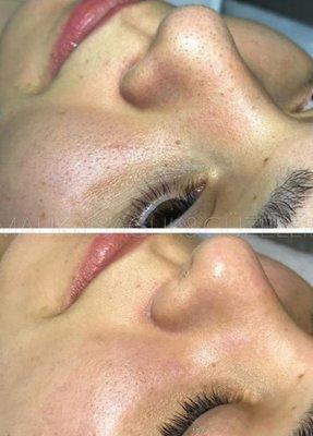 Dermaplaning facial Tx.